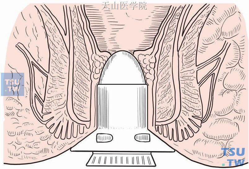 插入透明肛门镜并缝合固定在肛周皮肤上