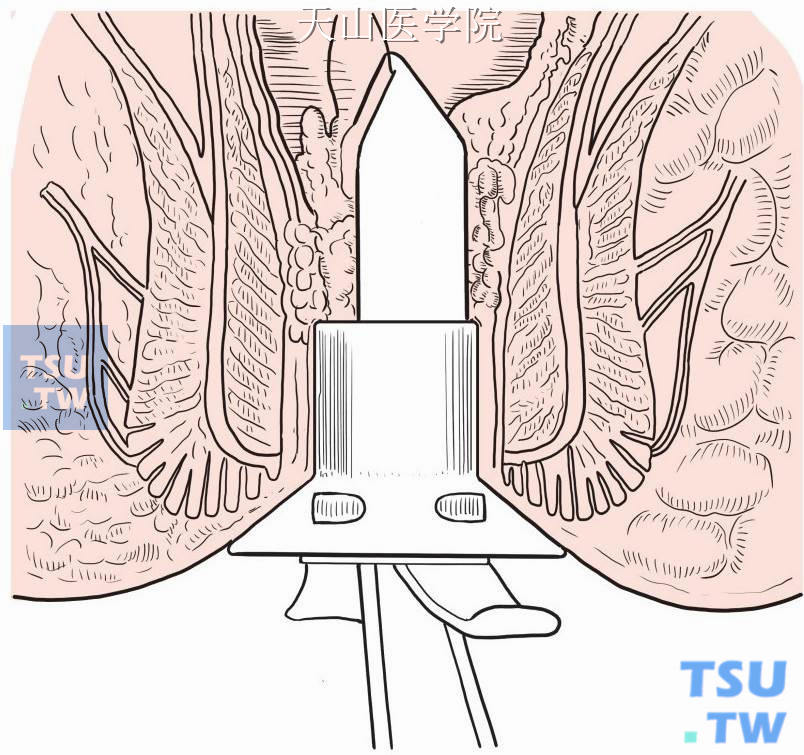 在齿状线上3cm处分别做肛管粘膜前、后两个半圈的粘膜下荷包缝合