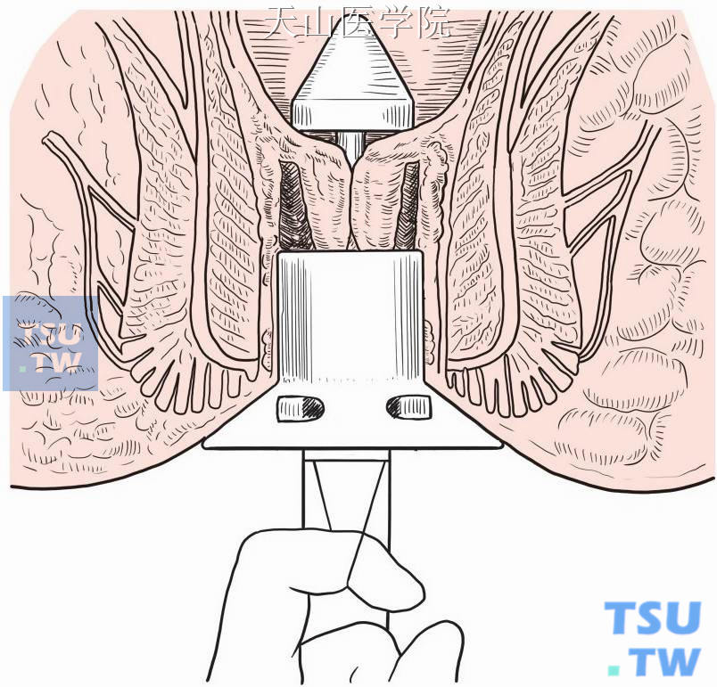 直肠吻合器原理图片