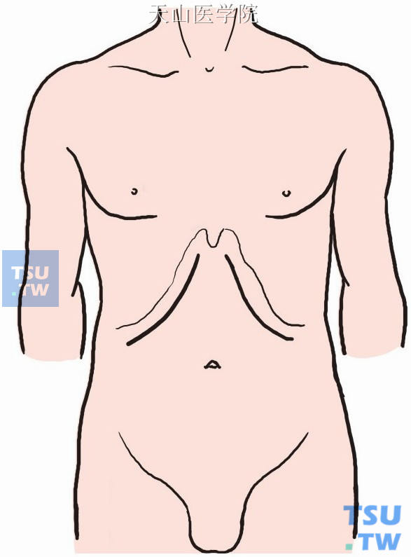 一般取右肋缘下1～2横指斜行切口，必要时可向左侧延长；左叶肿瘤也可取左肋缘下切口