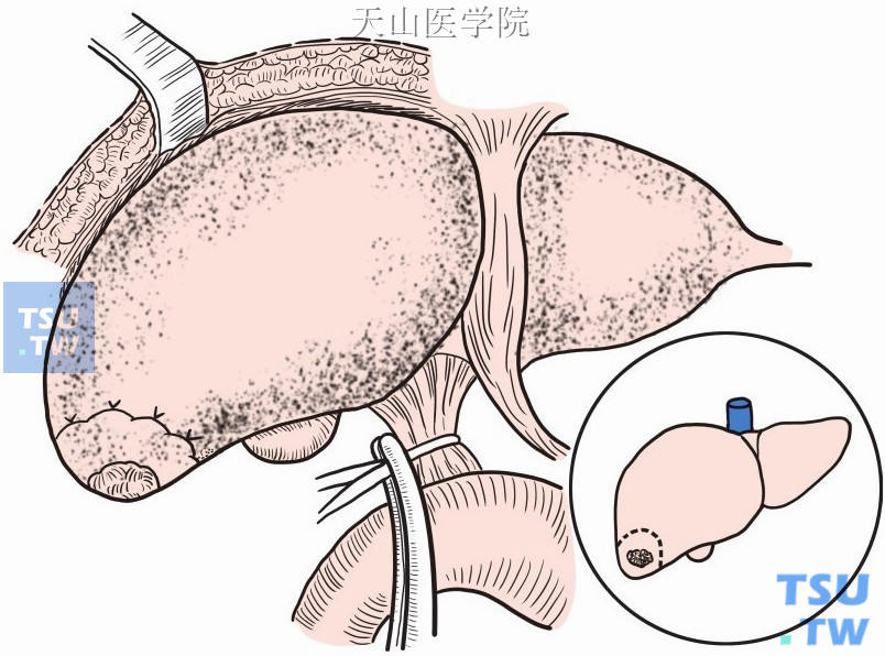 阻断第一肝门