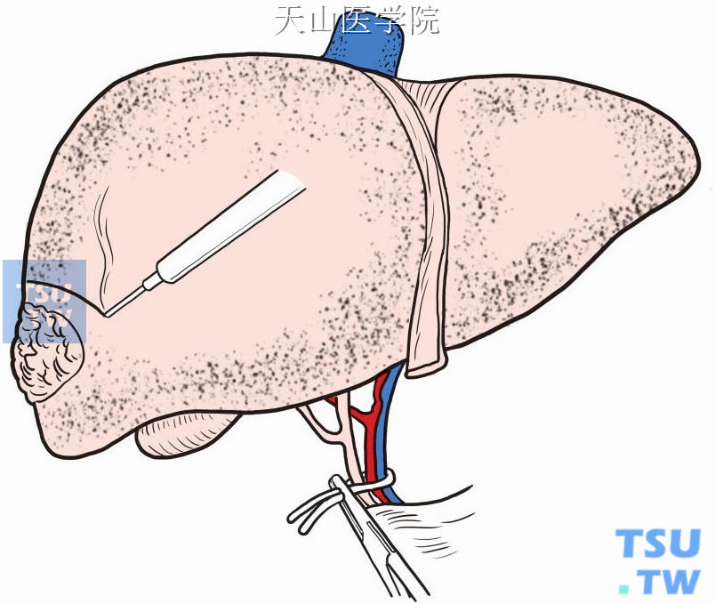 电刀切开肝包膜和浅表肝组织