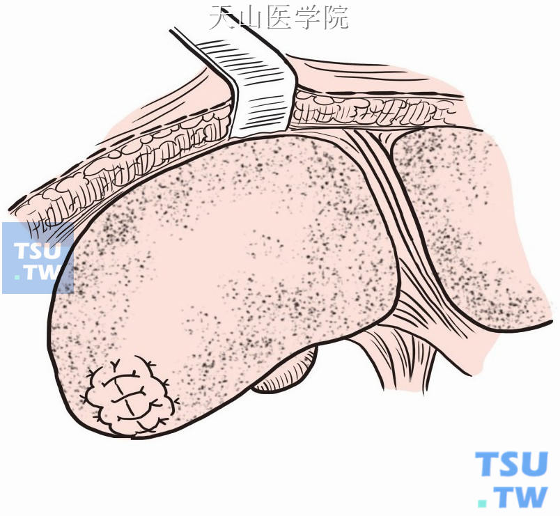 创面对拢缝合