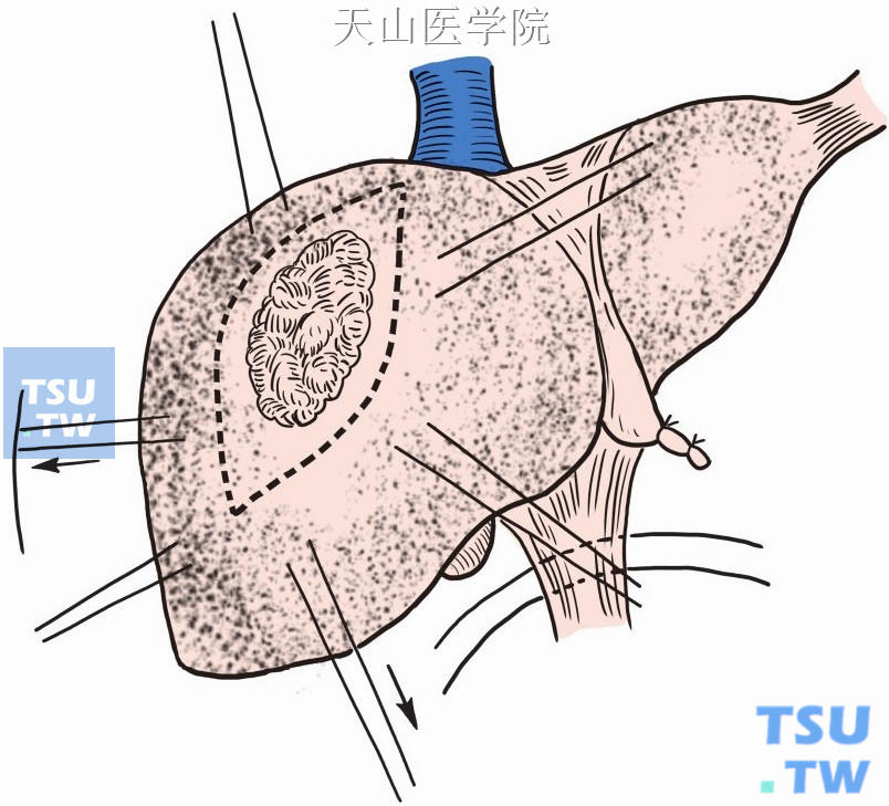 肿瘤边缘缝扎止血