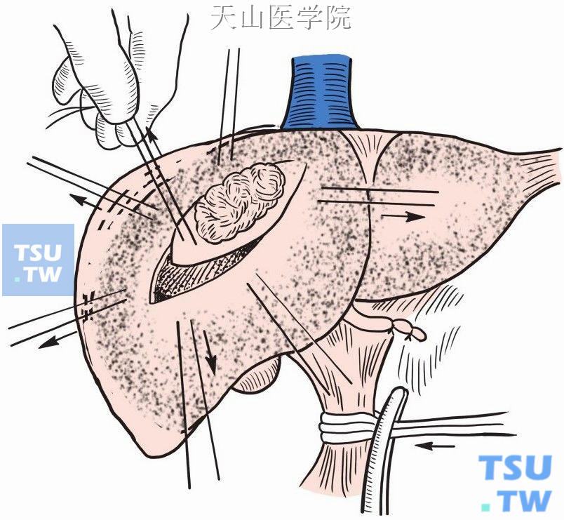 切开肝包膜和浅表肝组织