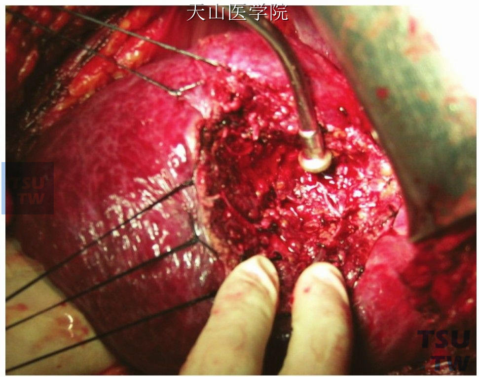 缝扎肝断面出血点和胆漏管道