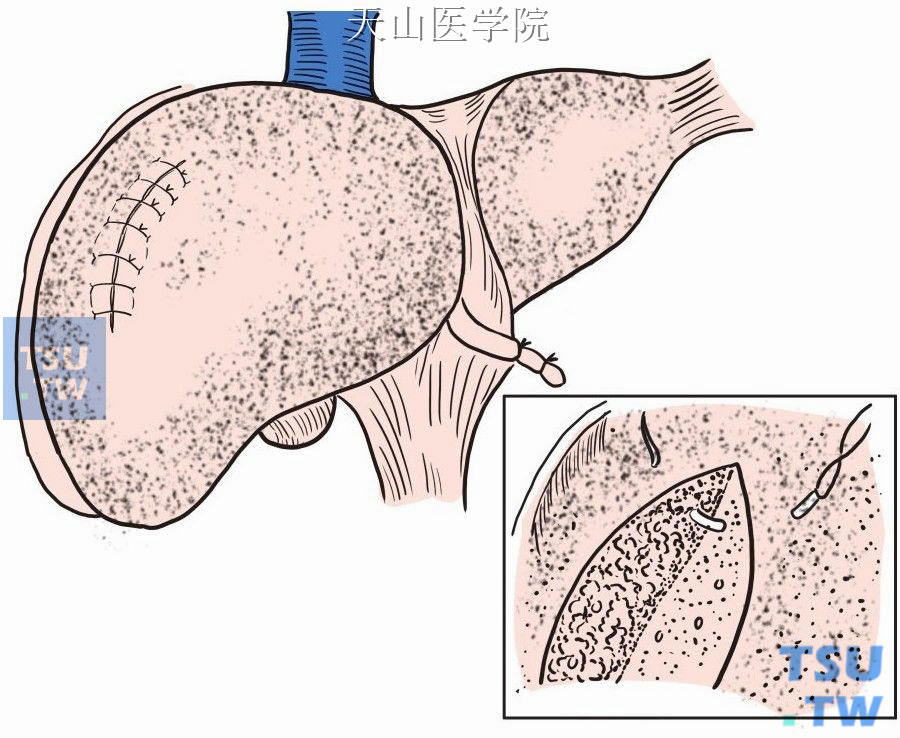 肝脏创面对拢缝合