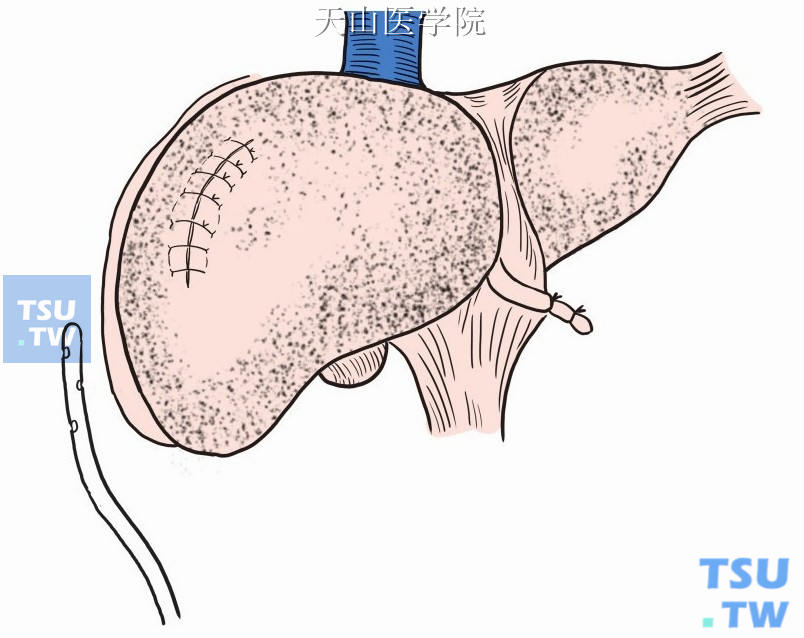 手术区置乳胶管引流