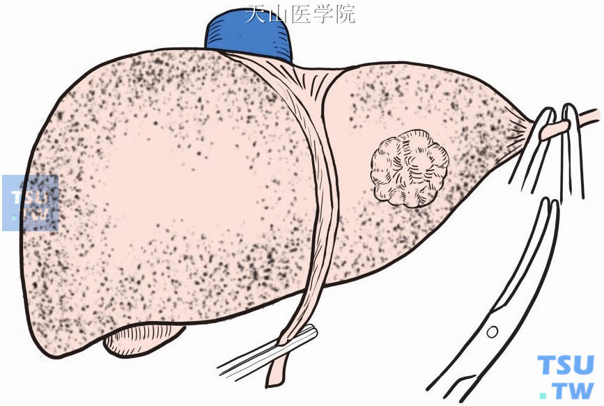肝左外叶切除术