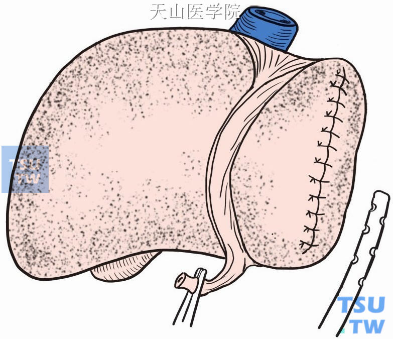 左肝断面旁放置乳胶管引流