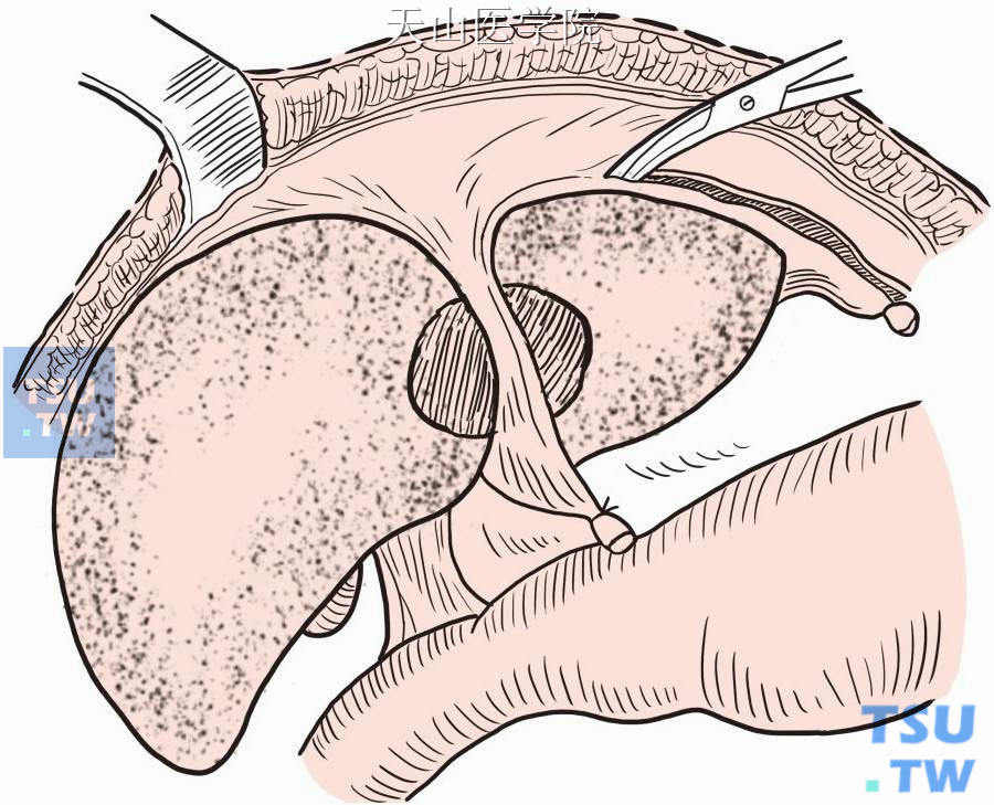 离断肝周韧带