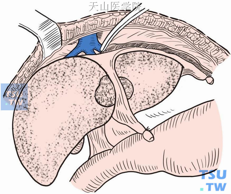 显露出肝左和肝中静脉根部