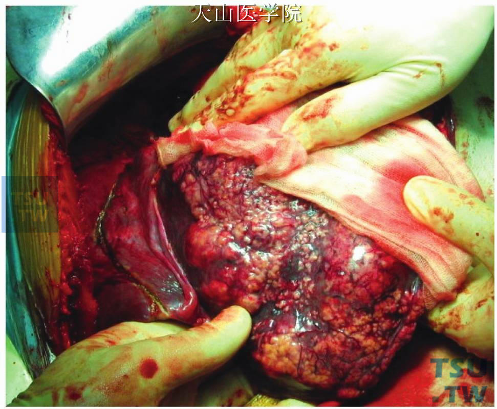 沿肝正中裂左侧切开肝包膜
