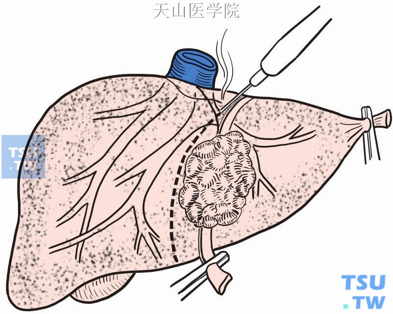 肝包膜图片图片