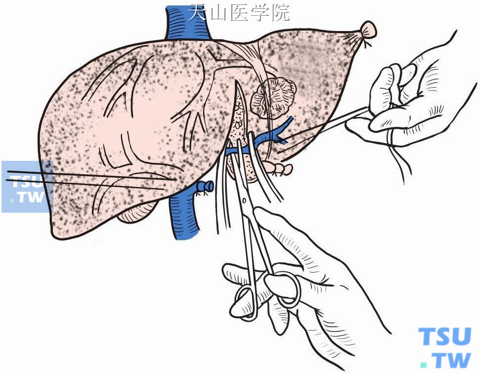 钳夹切断结扎管道