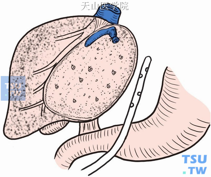肝断面旁放置引流