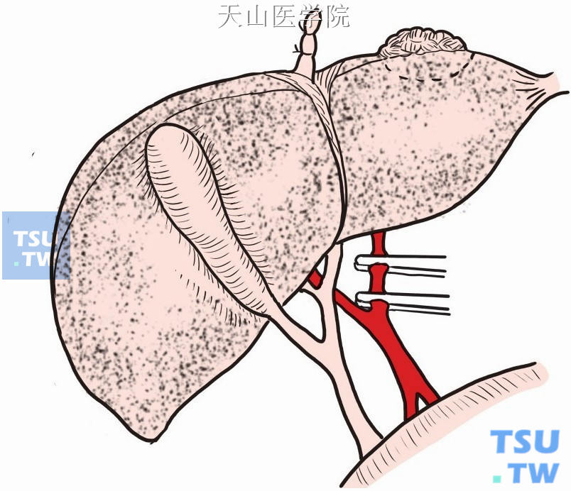 离断结扎肝左动脉