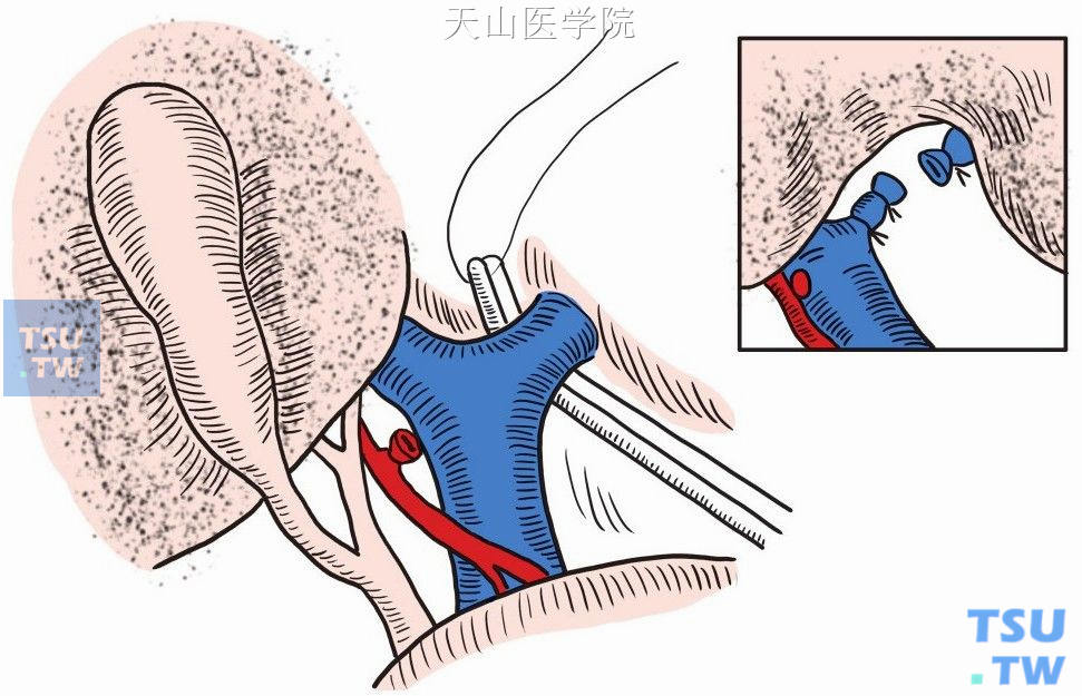 门静脉左支离断结扎