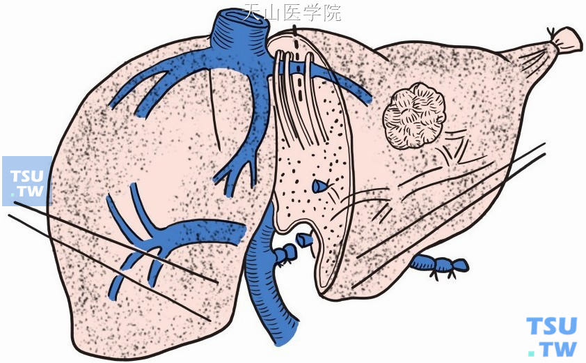 离断肝实质和肝左静脉