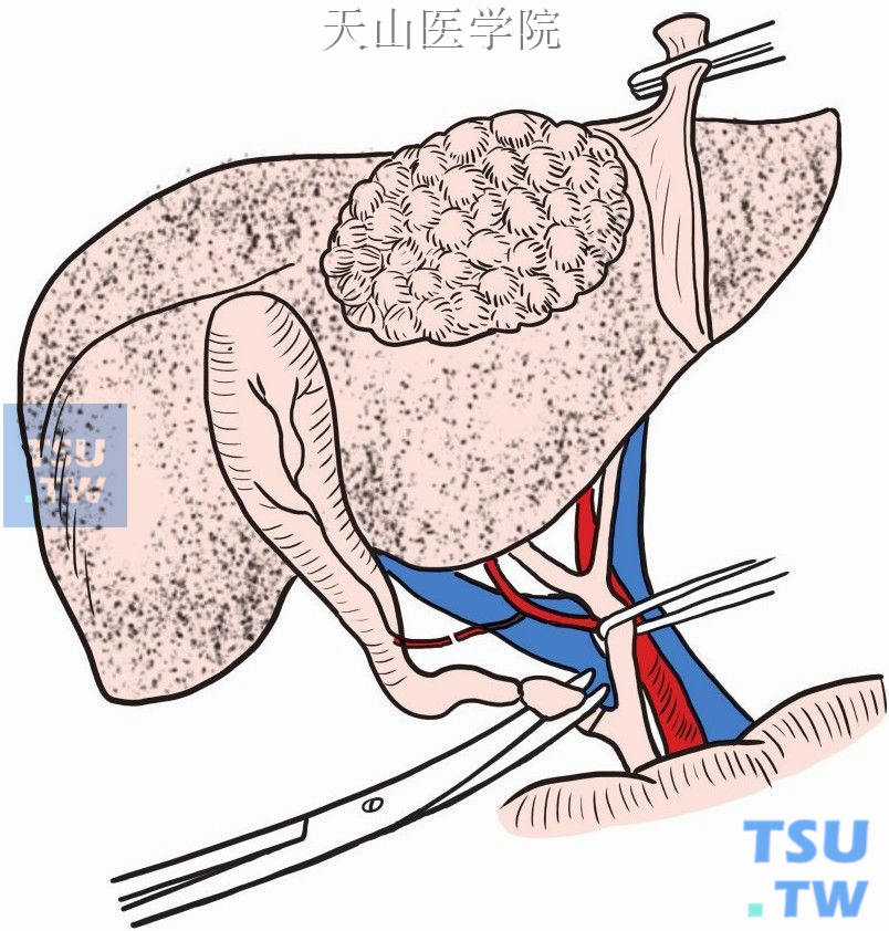 分离出胆囊管和胆囊动脉