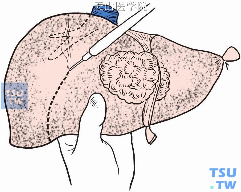 电刀切开预切线的肝包膜