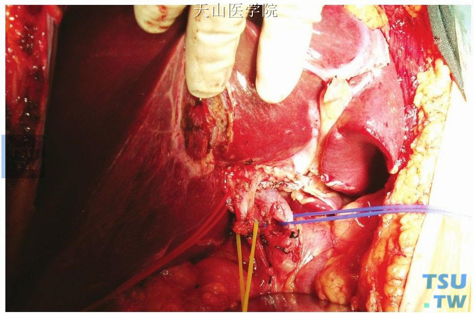切断结扎肝右前叶门静脉、肝动脉和胆管分支
