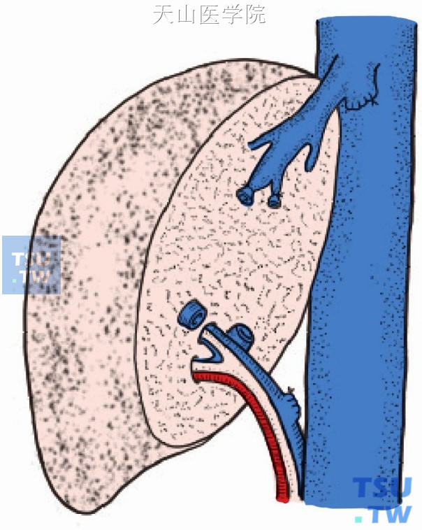 肝中静脉和肝左静脉残端仔细缝闭