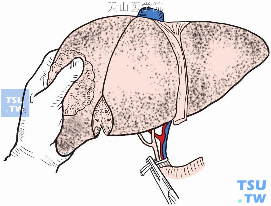 电刀沿标记线切开肝包膜，左手托起右肝，自下而上钝性分离肝实质，逐一钳夹、结扎、切断所遇管道