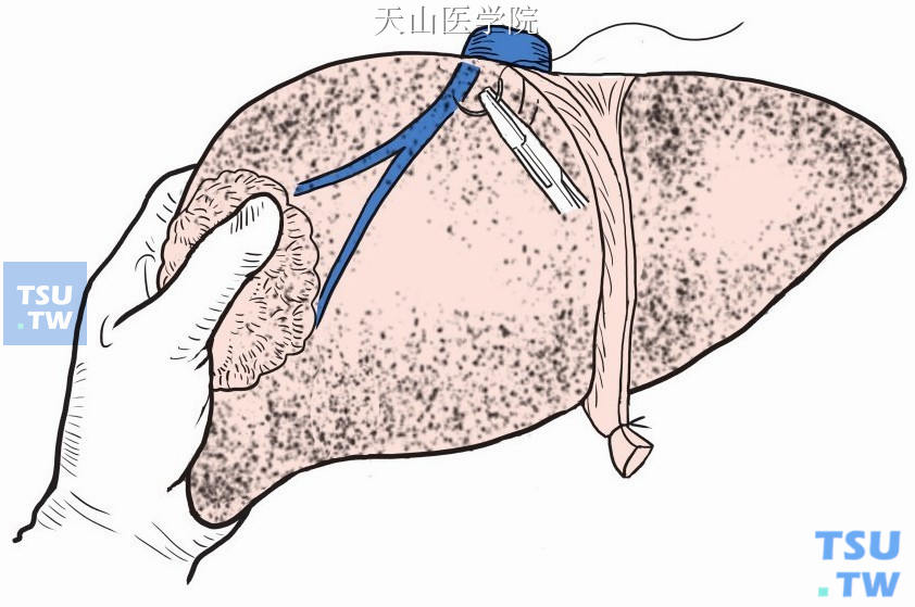 肝右静脉缝扎处理