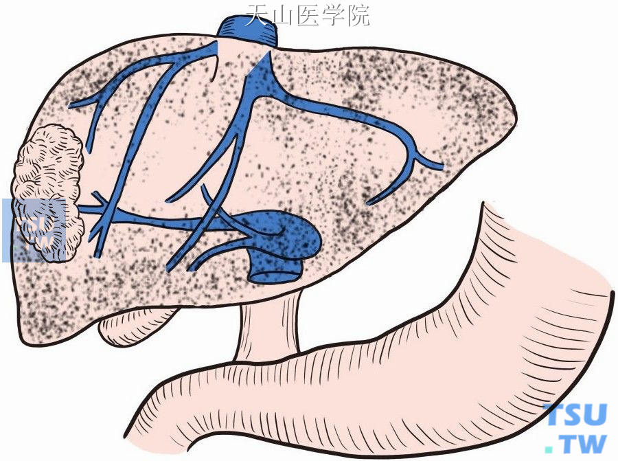 肝右叶门静脉支在肝表面无明显标志，须熟悉其肝内走行