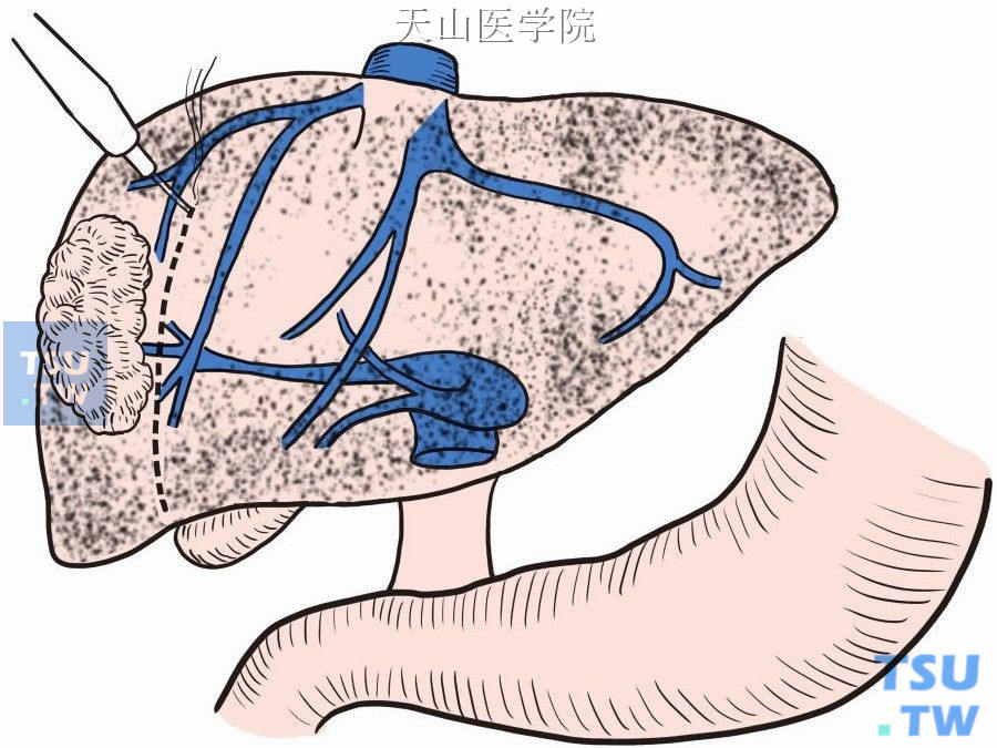 肝右间裂右侧0.5～1cm处电刀标记为切线