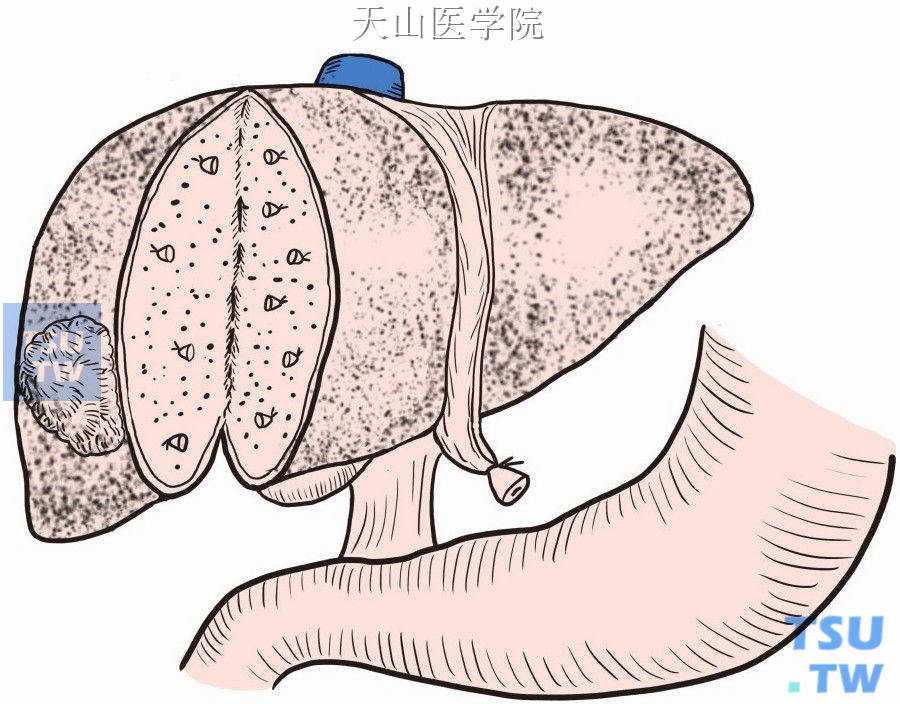 左手托起右肝，切开肝包膜，血管钳钝性分离肝实质，自下而上逐一钳夹、切断、结扎所遇管道