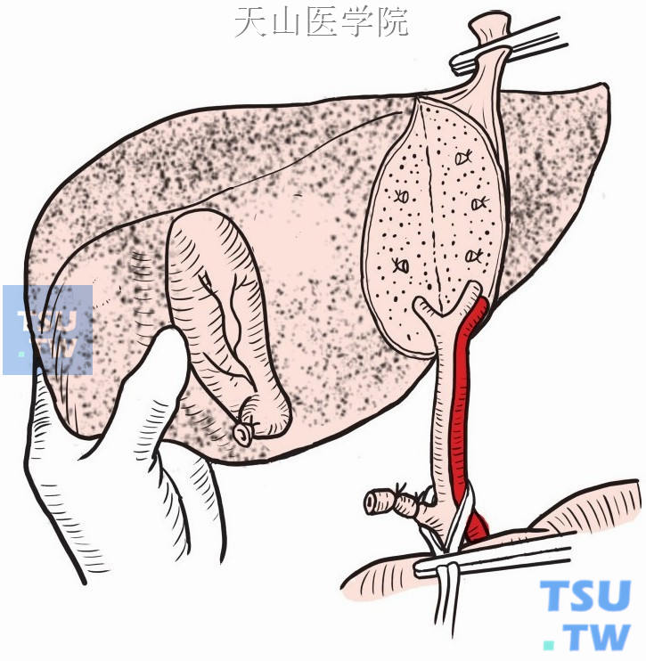 沿左叶间裂右侧切开