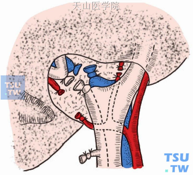 右肝管、门静脉右支和肝右动脉分别结扎切断
