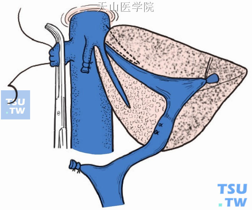 肝右和肝中静脉残端仔细缝闭