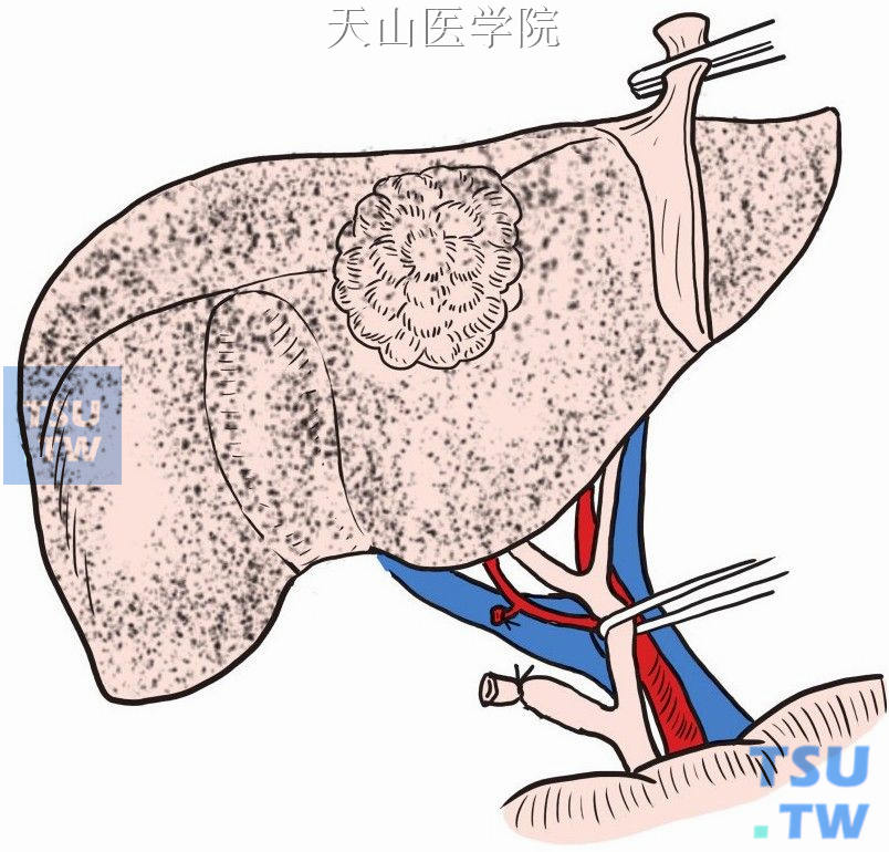 切断结扎胆囊管和胆囊动脉