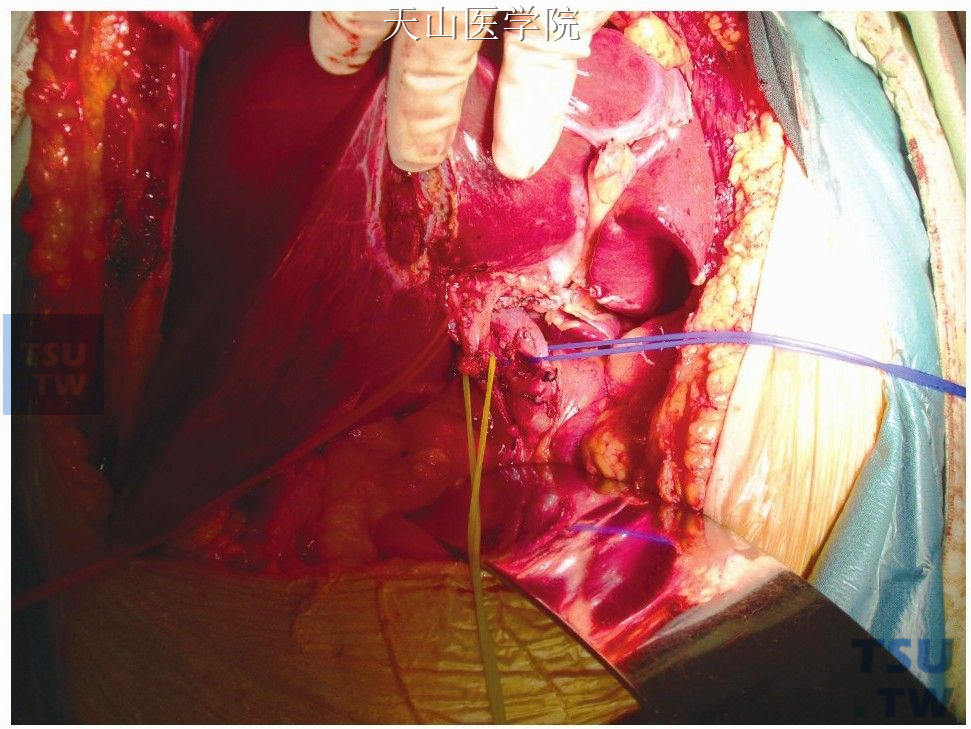 肝门部解剖分离