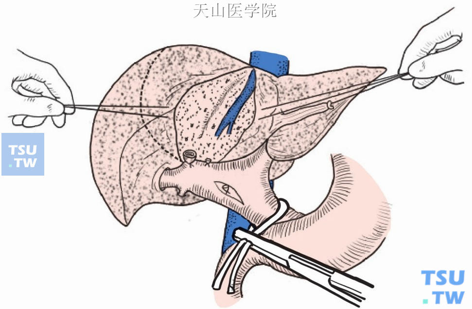 镰状韧带右缘切开肝包膜