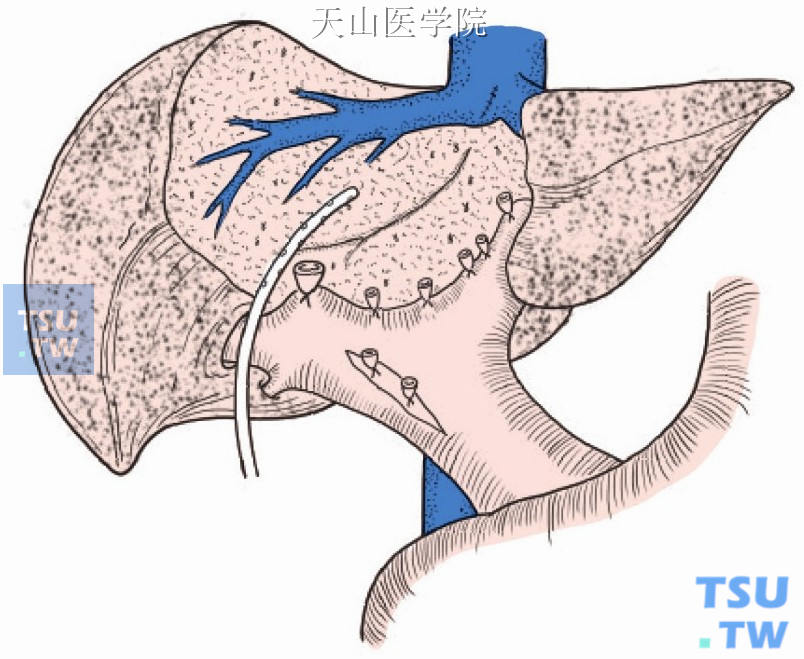 肝断面旁放置乳胶管引流