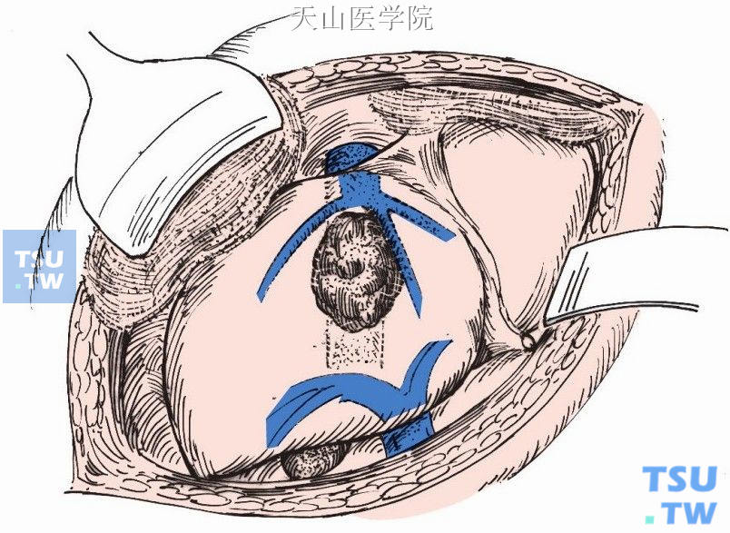 肿瘤明确在肝Ⅷ段