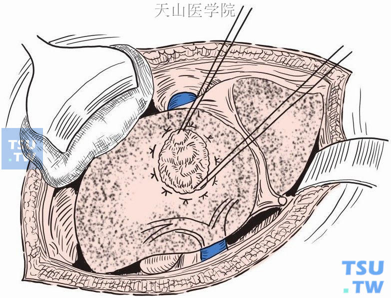 预切线外粗丝线缝扎浅表肝组织一周