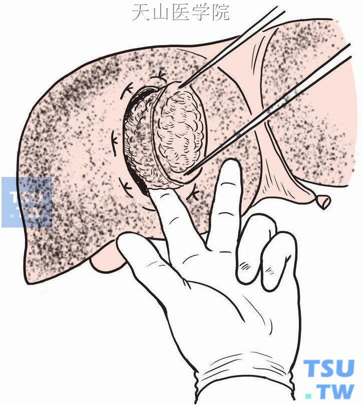 以手指钝性离断肝组织