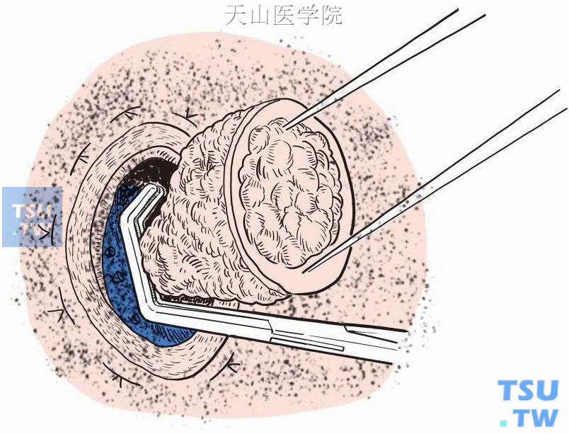 心耳钳紧贴肿瘤钳夹，切除部分正常下腔静脉壁