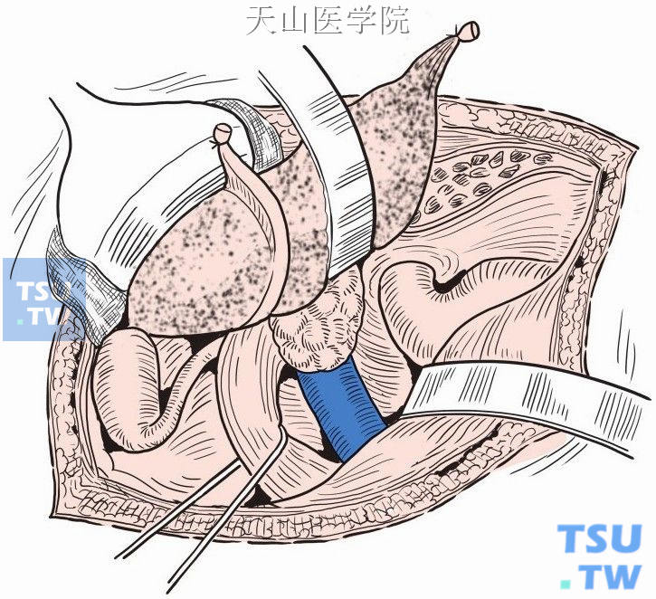 显露尾状叶