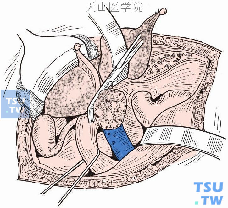 如肿瘤中部侵犯下腔静脉壁，则停止游离，改由上向下游离