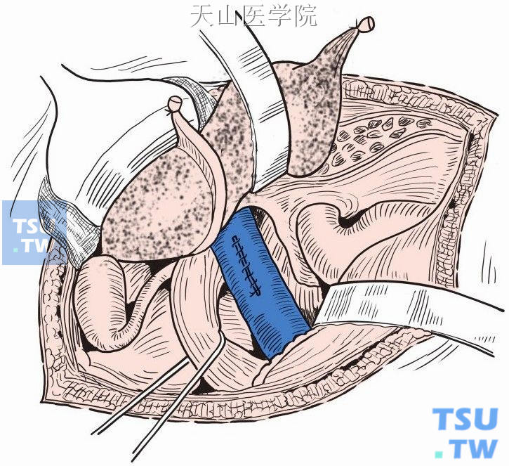 缝合下腔静脉壁