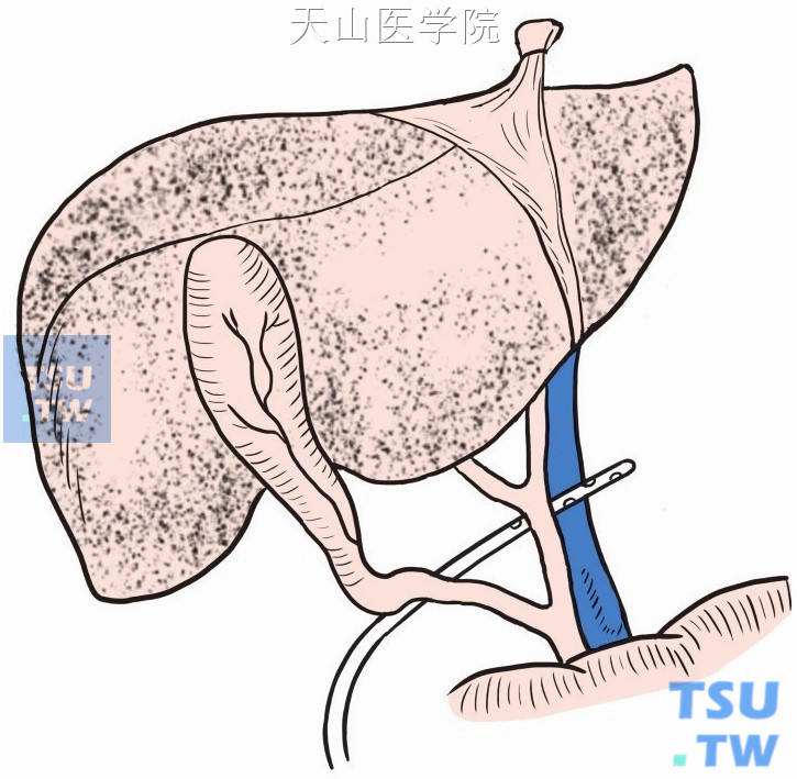 放置乳胶管引流