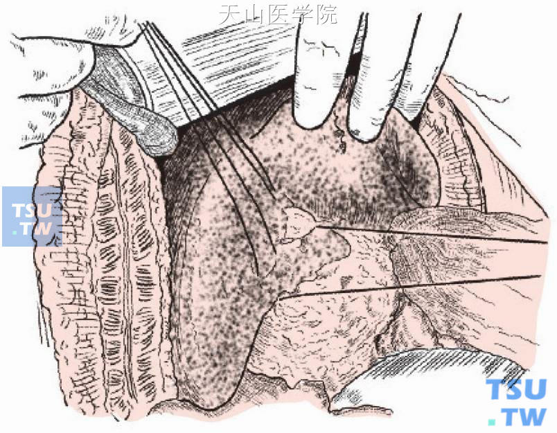 游离肝结肠韧带、右冠状韧带全层，打开裸区，充分游离右半肝并向左翻起显露肿瘤
