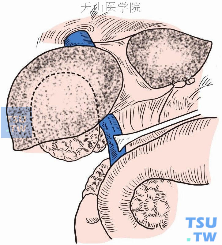 切断右三角韧带和冠状韧带后切开肝肾韧带和下腔静脉前腹膜，游离右肝直至下腔静脉右侧壁