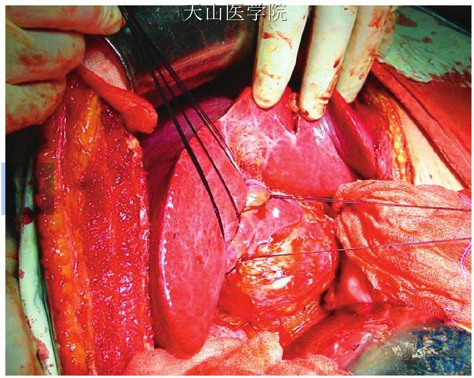 肝尾状叶切除术